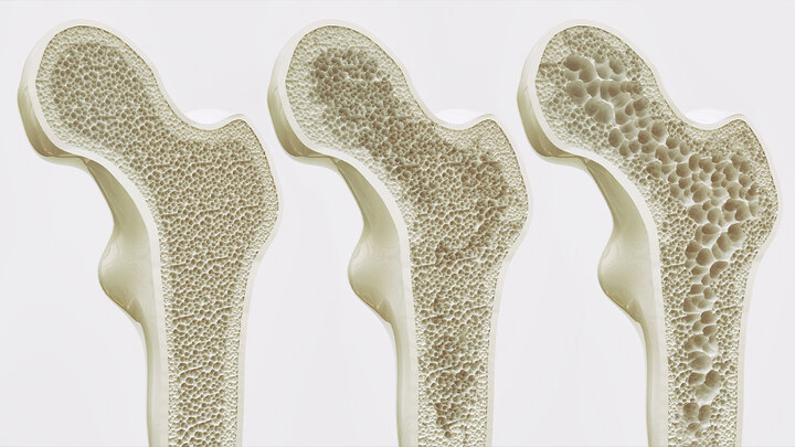 درمان پوکی استخوان در دوره یائسگی با «نانوذرات سلنیوم»