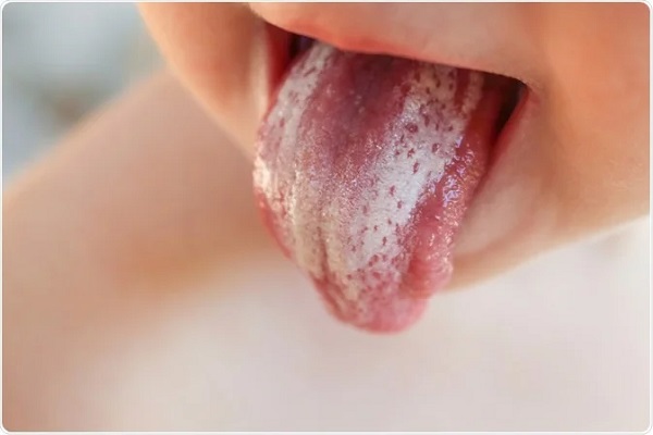 برفک دهان چیست؟/ روش‌های خانگی برای درمان