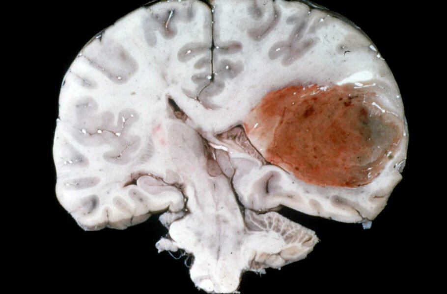 درمان جدید سرطان، اندازه یک تومور مغزی کشنده را در عرض چند روز کاهش داد