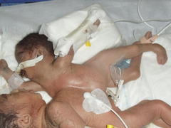 تولد نوزاد دوقلوی بهم چسبیده در یزد+عکس