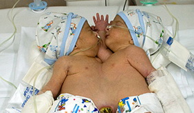 عکس:دوقلوهای به هم چسبیده متولد شده در یزد 