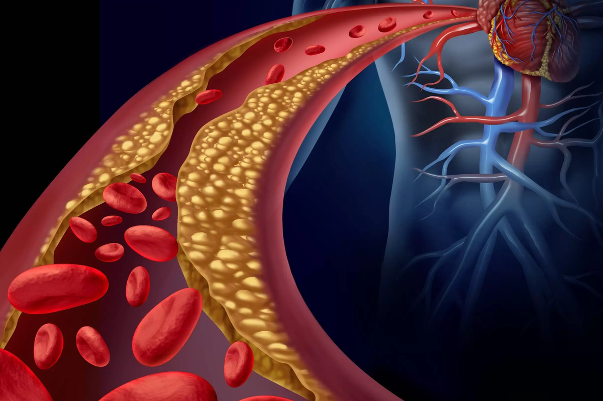 زنگ خطر‌هایی که نشان دهنده کلسترول بالاست