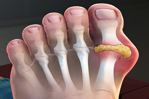 داروهای نقرس به سلامت قلب نیز کمک می‌کنند